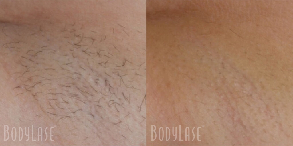 bodylase_laser-hair-removal_patient-01a