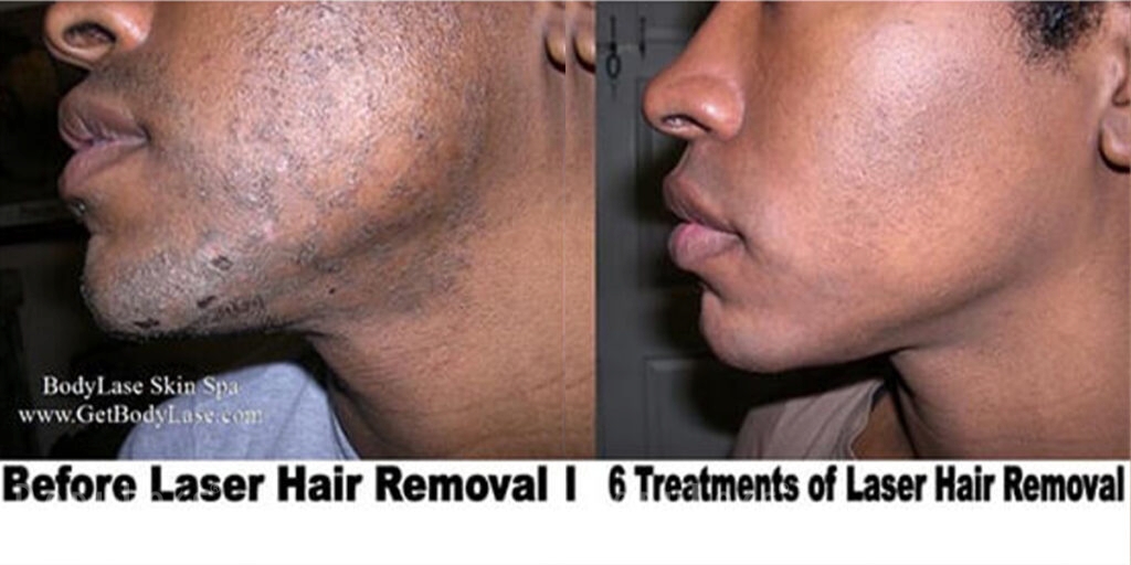 bodylase_laser-hair-removal_patient-02a
