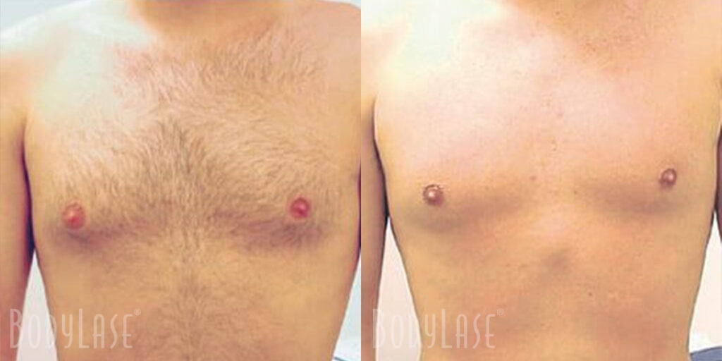 bodylase_laser-hair-removal_patient-04a