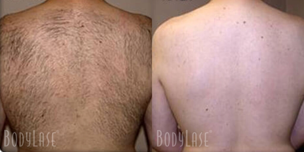 bodylase_laser-hair-removal_patient-05a