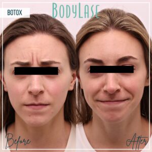 Botox client