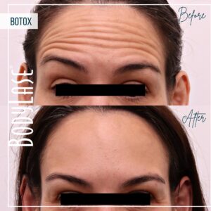 bodylase_botox_patient-6b