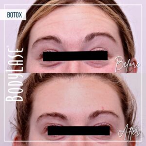 bodylase_botox_patient-8b