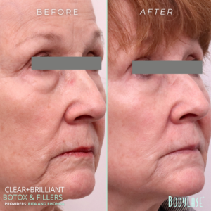 Clear + Brilliant and Filler client