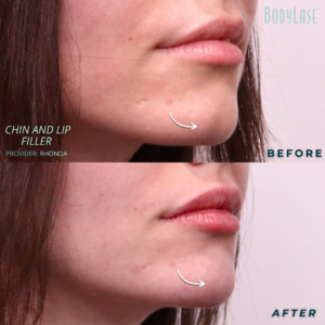 B&A Filler