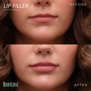 B&A Lip Filler