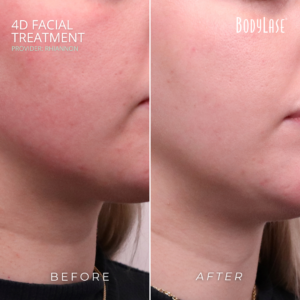 BodyLase 4D Facial