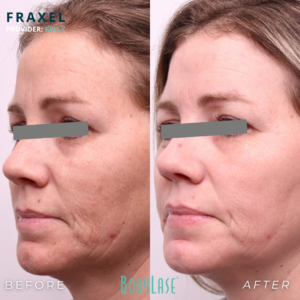 BodyLase Fraxel3