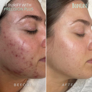 BA-VI-Peel-Precision-Plus-from-Brand-Box-