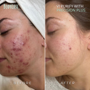 BA-VI-Peel-Precision-Plus-from-Brand-Box-1