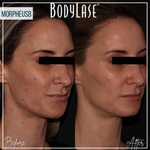 Bodylase_Morpheas8_BA_Pateint-2-Oblique1