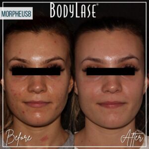 Bodylase_Morpheas8_BA_Pateint-3-FRONT