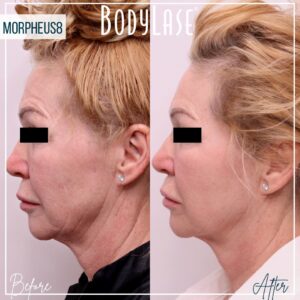 Bodylase_Morpheas8_BA_Pateint1-Side-2