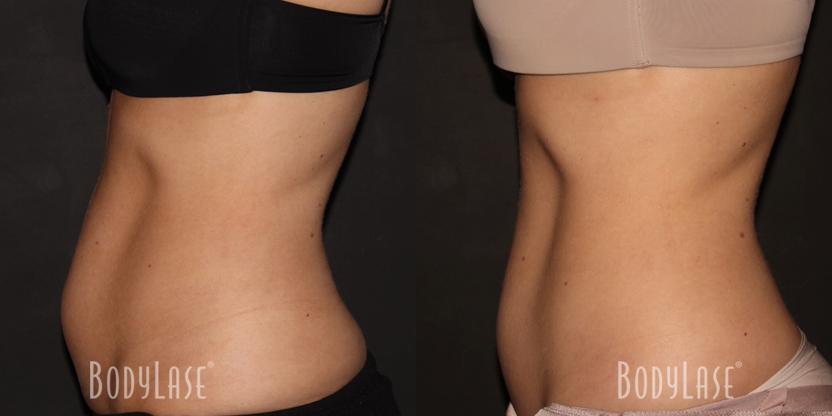 bodylase_coolsculpting_patient-01a