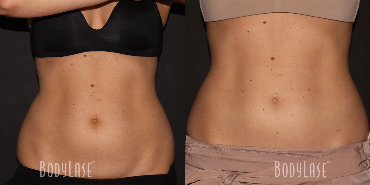 bodylase_coolsculpting_patient-01b
