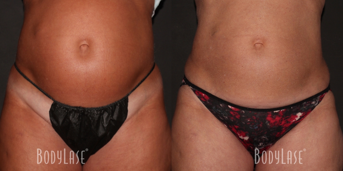 bodylase_coolsculpting_patient-02a