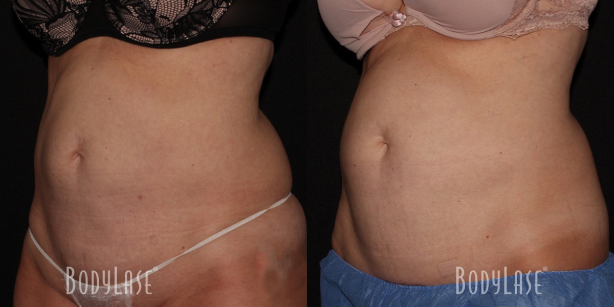 bodylase_coolsculpting_patient-03a
