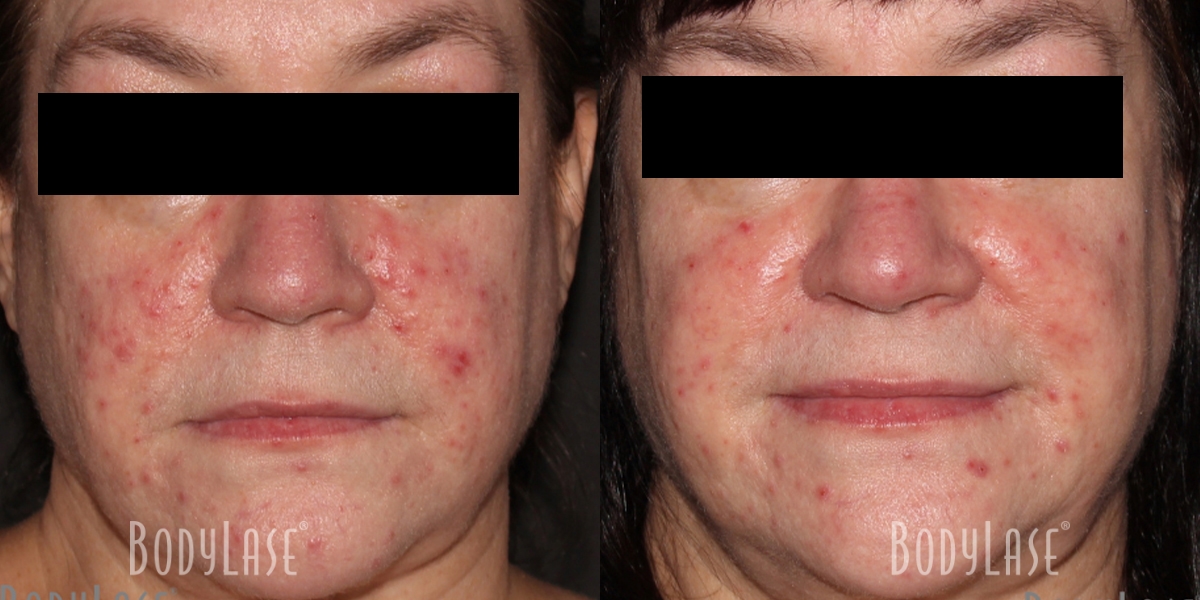 getbodylase_beforeandafters_assets__0000_2D-4D-Patient2a