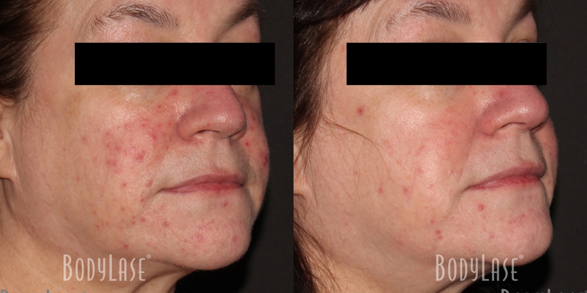 getbodylase_beforeandafters_assets__0001_2D-4D-Patient2b