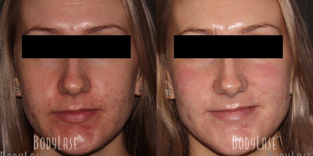 getbodylase_beforeandafters_assets__0002_2D-4D-Patient3a