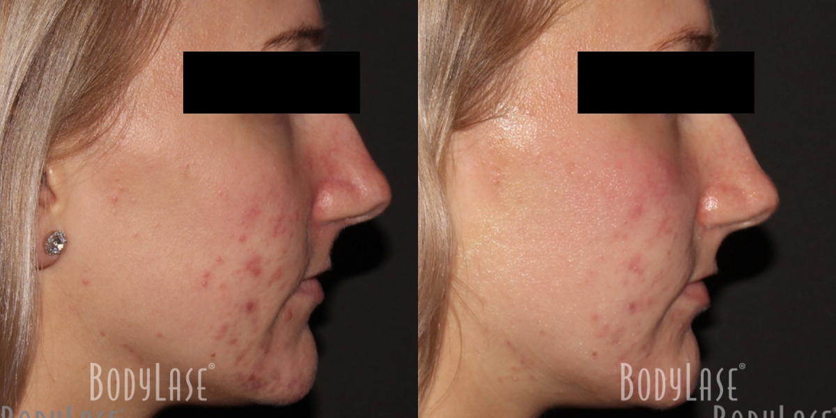 getbodylase_beforeandafters_assets__0003_2D-4D-Patient3b