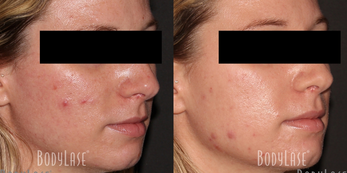 getbodylase_beforeandafters_assets__0004_2D-4D-Patient4a