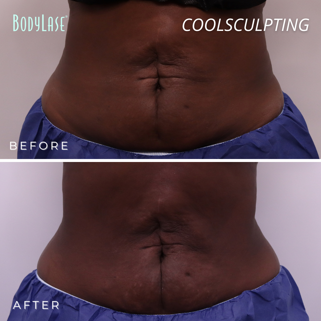 BodyLase CoolSculpting Female Abdomen
