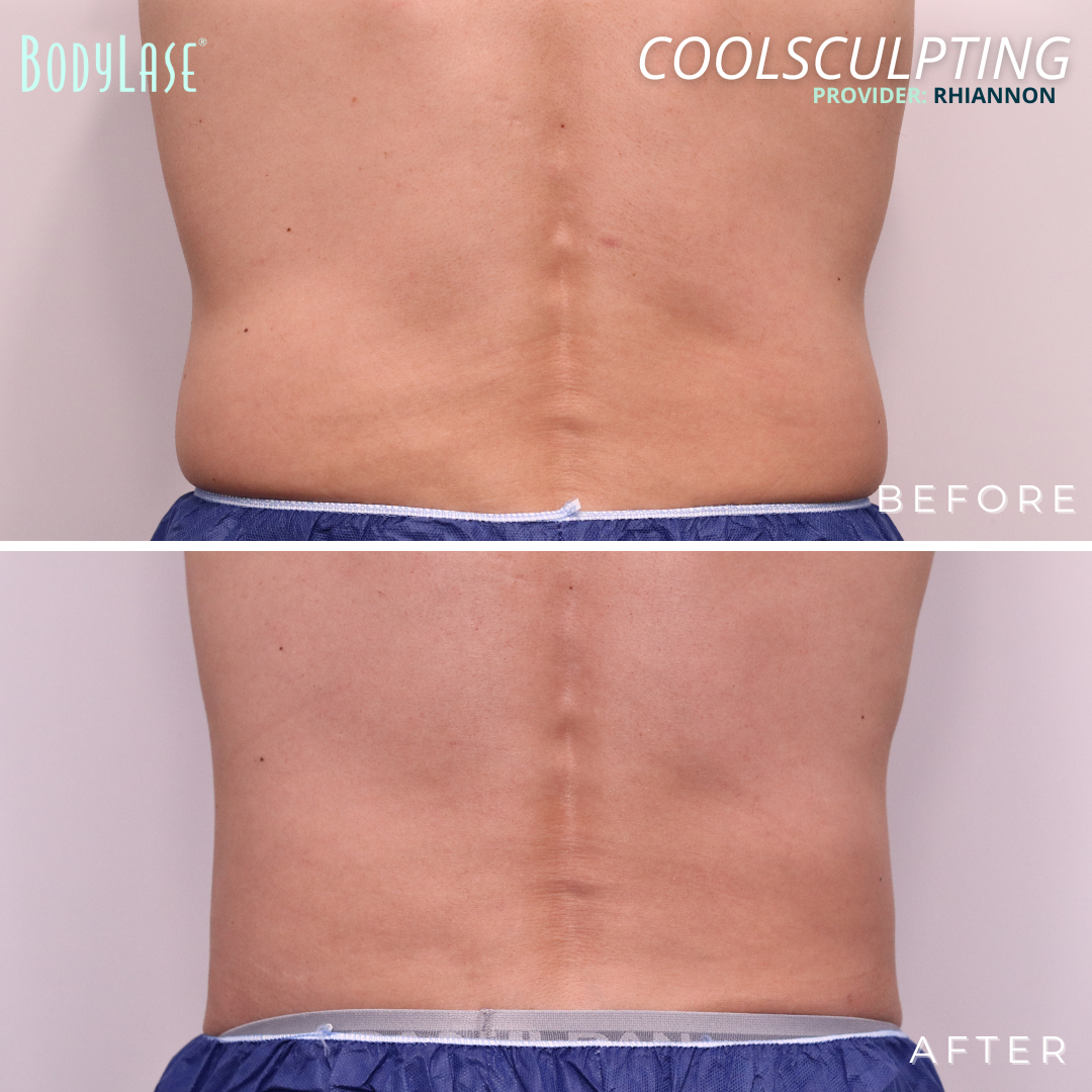 BodyLase CoolSculpting Male Abdomen