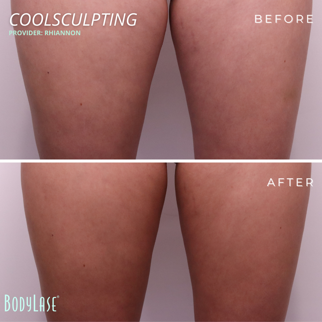 BodyLase CoolSculpting Thighs