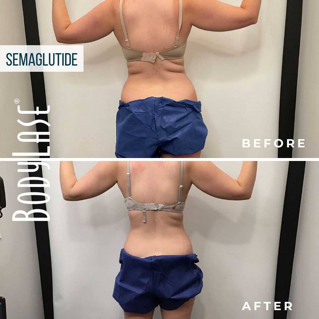 Semaglutide BodyLase B&A back