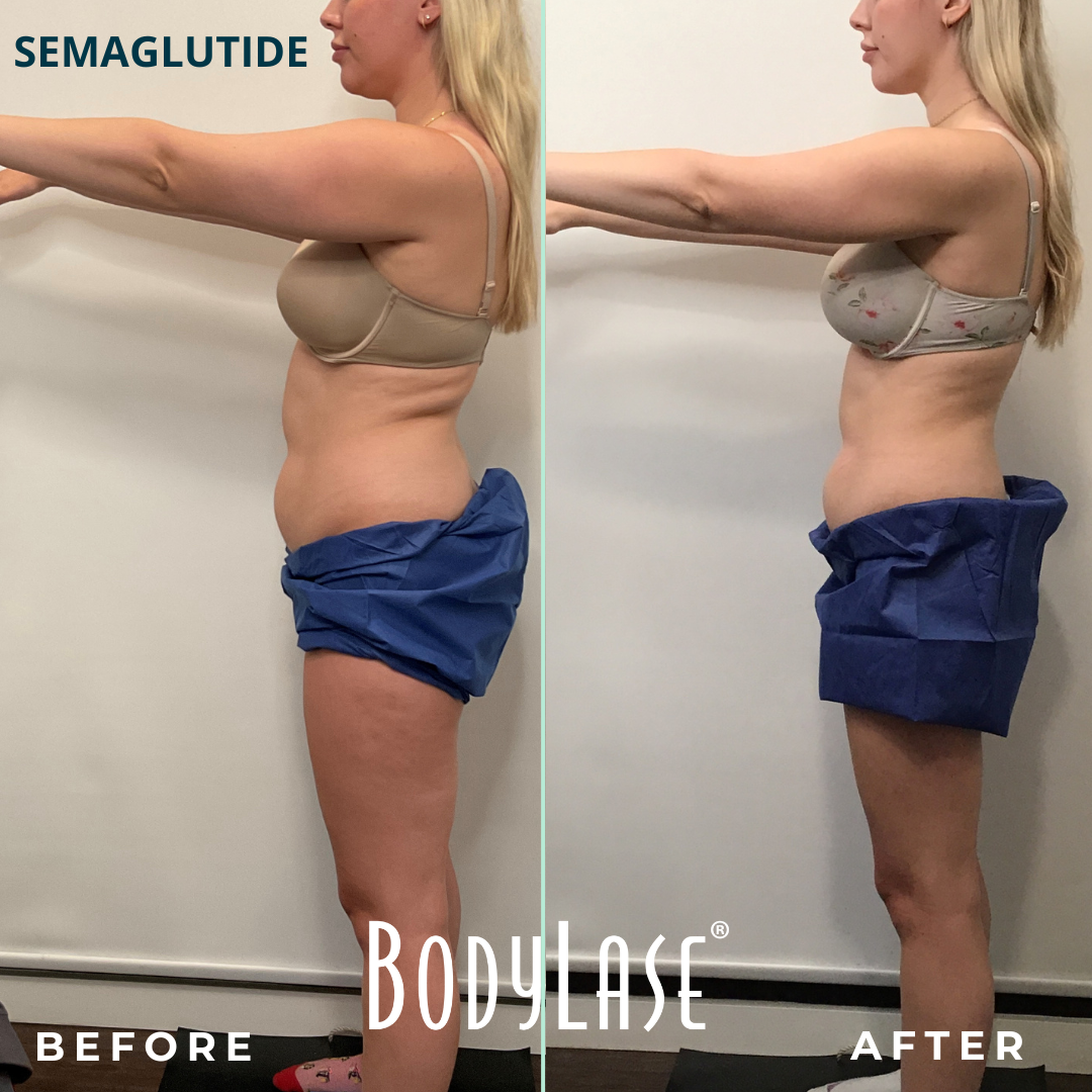 Semaglutide BodyLase B&A side view